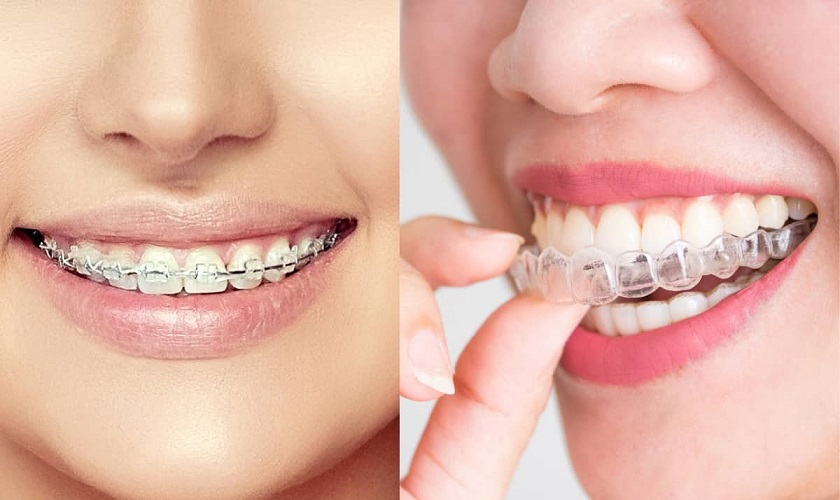 Vậy nên lựa chọn sử dụng loại niềng răng nào?