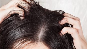 5 Cách trị gàu da đầu dứt điểm ngay tại nhà