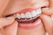 Đánh giá mức độ hiệu quả của các phương pháp niềng răng hiện nay