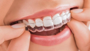 Đánh giá mức độ hiệu quả của các phương pháp niềng răng hiện nay
